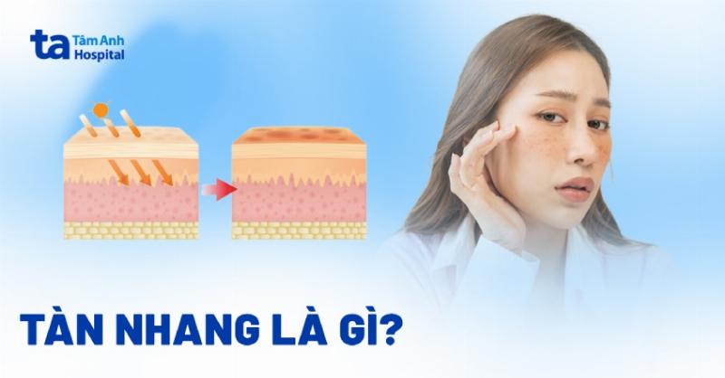 Hình ảnh minh họa tàn nhang trên da mặt với các đốm sắc tố nhỏ màu nâu nhạt phân bố rải rác, thể hiện rõ đặc điểm của tàn nhang ephelides.